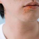 Quand le stress s’invite sur la peau : comprendre et apaiser le psoriasis